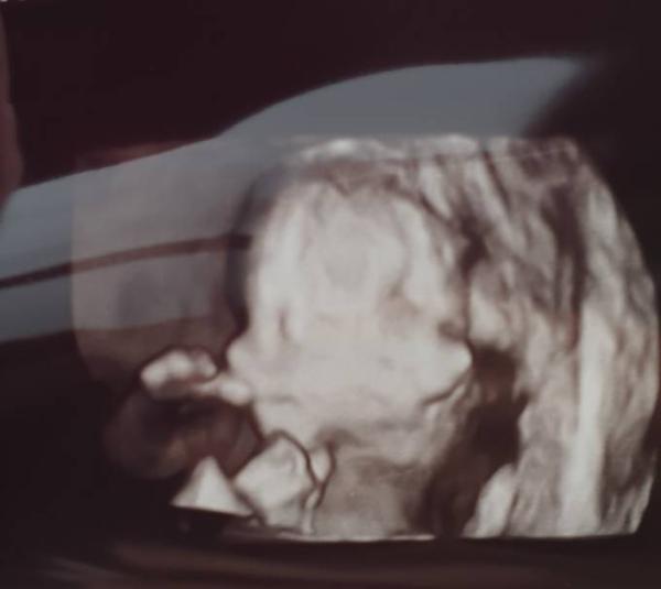 Bild zu Letzter Termin vor Organscreening - Forum für November - Mamis