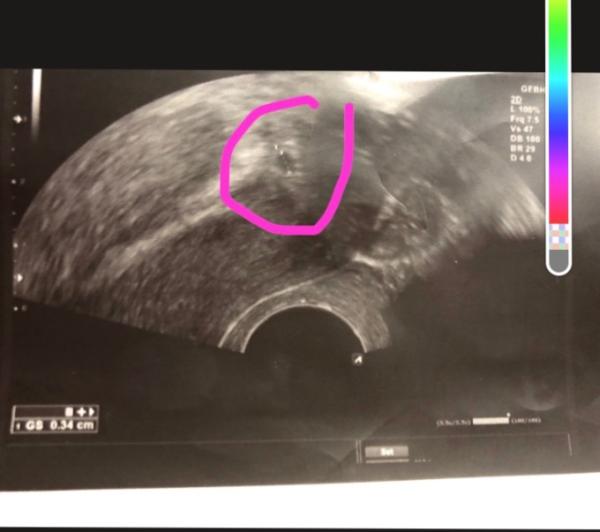 Bild zu Erster Frauenarzt Besuch - Verdacht auf Eileiter Schwangerschaft - Forum für November - Mamis