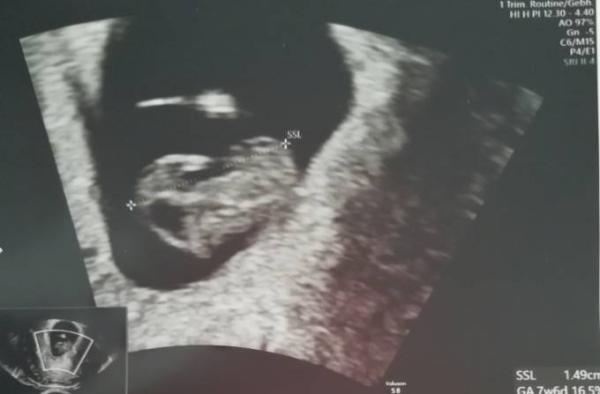 Bild zu Mein neuer Begleiter, ein Hämatom - Forum für November - Mamis