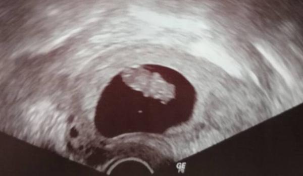 Bild zu 2.Termin 1.offizieller Schall - Forum für November - Mamis