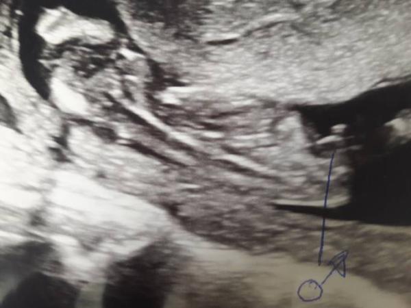 Bild zu Ersttrimesterscreening und Geschlecht - Forum für November - Mamis