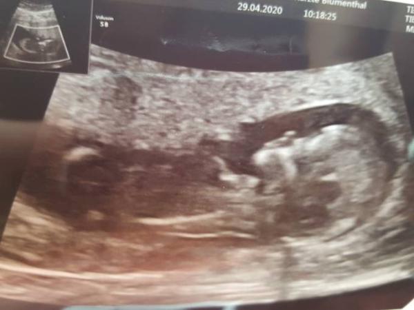 Bild zu Nackenfaltenmessung - Forum für November - Mamis