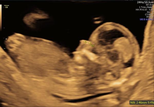 Bild zu Nackenfalte + ETS + Herztöne täglich zu Hause hören(Hilft bei Ängsten) - Forum für November - Mamis