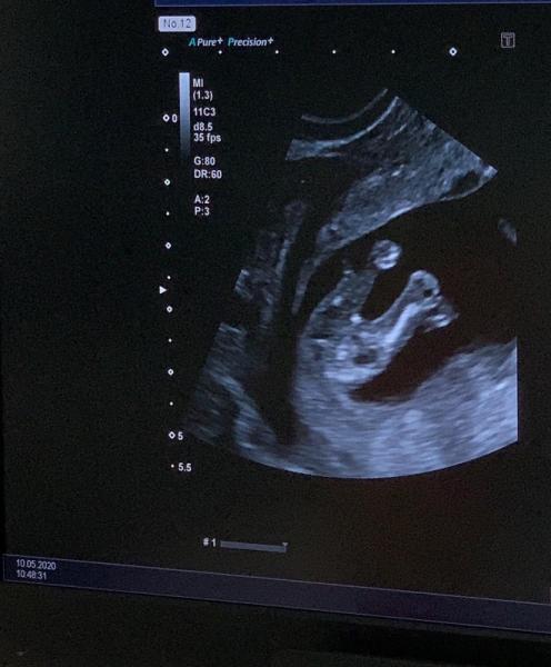 Bild zu Erstrimester Screening: junge oder Mädchen - Forum für November - Mamis