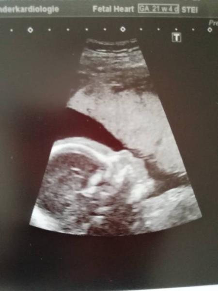 Bild zu Zurück von der Pränataldiagnostik - Etwas beunruhigt - Forum für November - Mamis