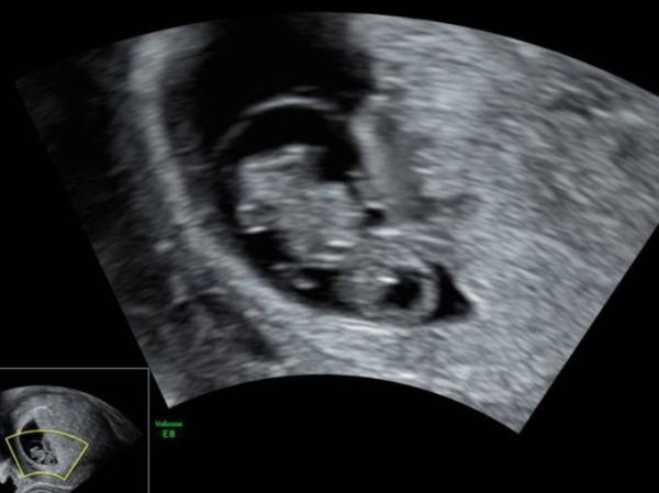 Bild zu Schwangerschaftsfeststellung und BV - Forum für November - Mamis