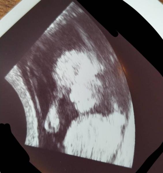 Bild zu 1. Ultraschalluntersuchung - Forum für November - Mamis