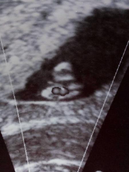 Bild zu Nach Ki-Wu-Behandlung endlich geschafft - Forum für November - Mamis