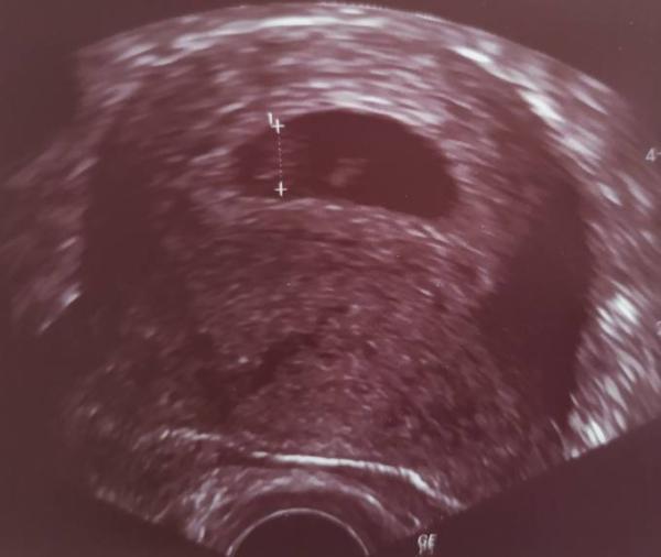 Bild zu Hallo kleine Blaubeere ♥️ - Forum für November - Mamis