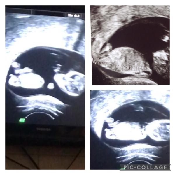 Bild zu Ultraschallbild - Forum für November - Mamis