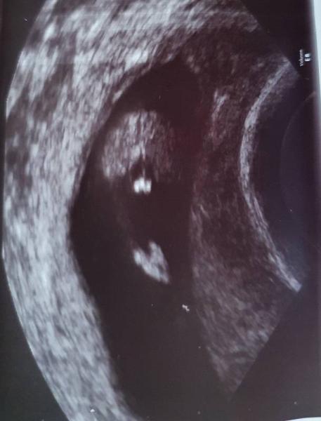 Bild zu Junge oder Mädchen 14.SSW? - Forum für November - Mamis