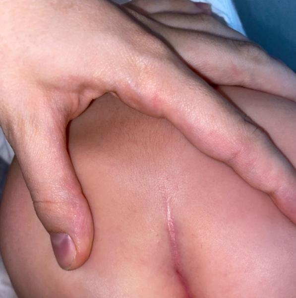 Bild zu Mache mir Sorgen um ihren Po - schon mal sowas gesehen? - Forum für November - Mamis