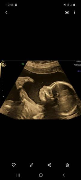 Bild zu 21ssw Organscreening - Forum für November - Mamis