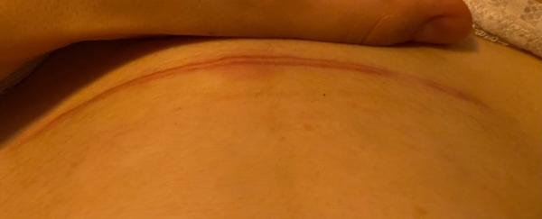Bild zu An die Kaiserschnitt-Mamis - Forum für November - Mamis
