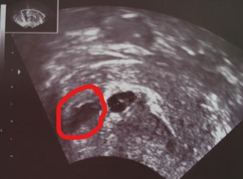 Bild zu Verwirrt 2 FH oder ein Hämatom - Forum für November - Mamis