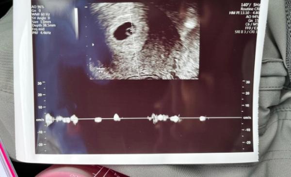 Bild zu Ssw 7 aber Embryo klein - Forum für November - Mamis