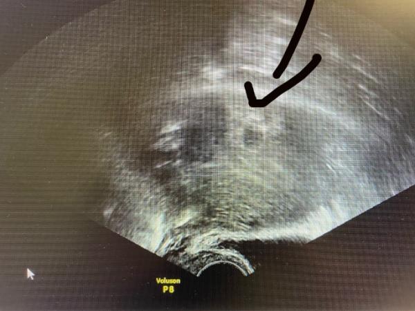 Bild zu FH und Dottersack, aber noch kein Embryo - Forum für November - Mamis
