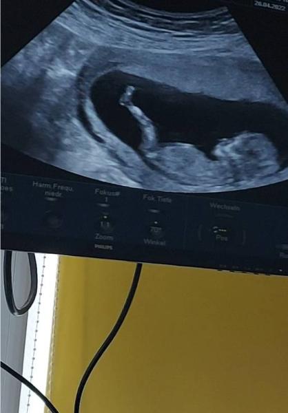Bild zu Ist ein Nub erkennbar? Bitte um Hilfe 🥰🥰🥰 - Forum für November - Mamis