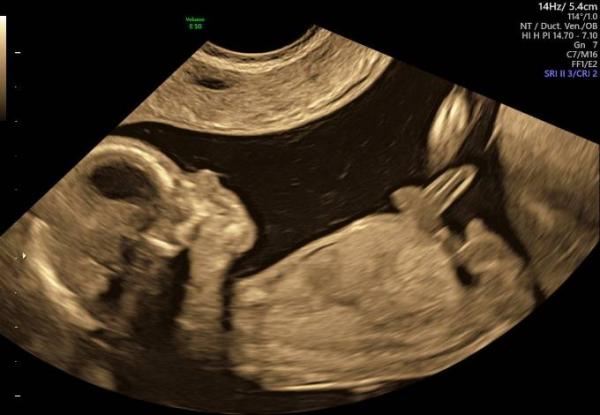 Bild zu Gestern Ultraschall mit Outing - Forum für November - Mamis