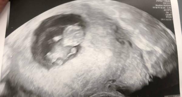 Bild zu Etwas mehr Hoffnung nach FA-Termin gestern - Forum für November - Mamis