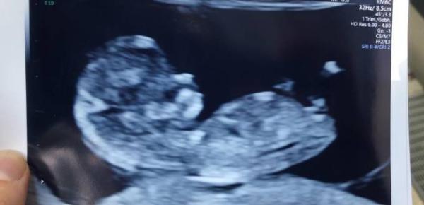 Bild zu Pränataldiagnostik - Forum für November - Mamis