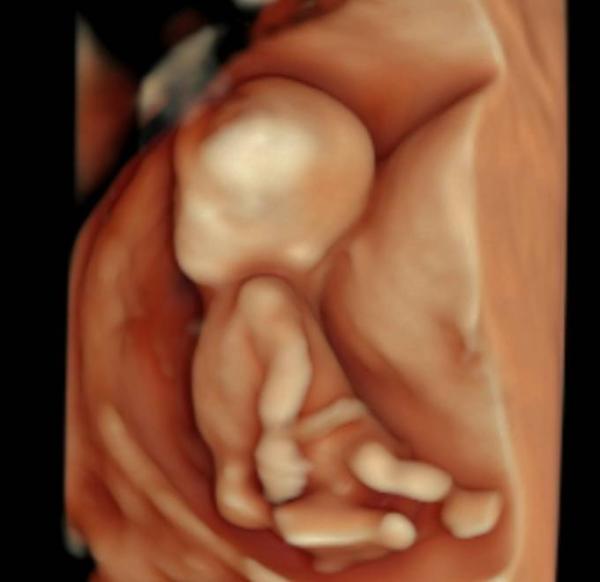 Bild zu Nackenfaltenmessung - Forum für November - Mamis