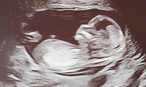 Bild zu Nackenfaltenmessung - Forum für November - Mamis