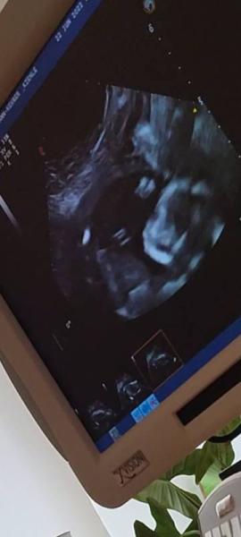 Bild zu 2. Großes Ultraschall 😍 - Forum für November - Mamis