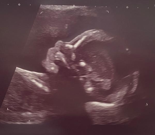 Bild zu Feindiagnostik - einmal komplett durchleuchtet 💙☀️ - Forum für November - Mamis