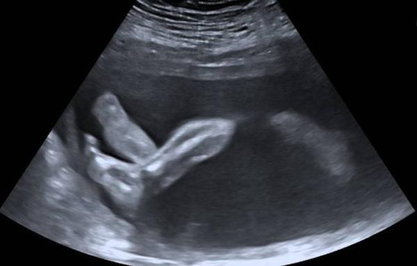 Bild zu Pränataldiagnostik - Forum für November - Mamis