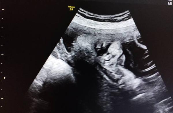 Bild zu Heute FA Termin. Baby geht's wohl besser als Mama - Forum für November - Mamis