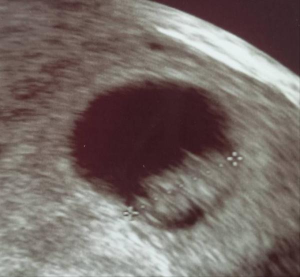 Bild zu 1 Trimester Screening - Forum für November - Mamis