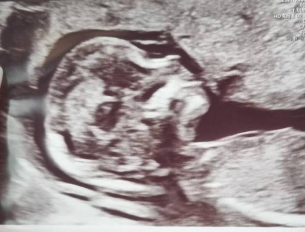 Bild zu Ersttrimester-Screening - Forum für November - Mamis