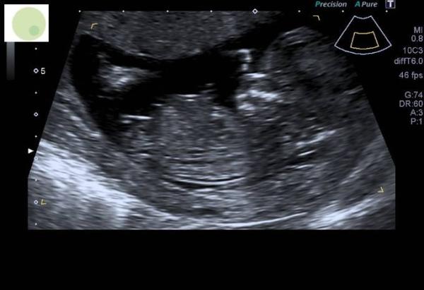 Bild zu Ersttrimester-Screening - Forum für November - Mamis