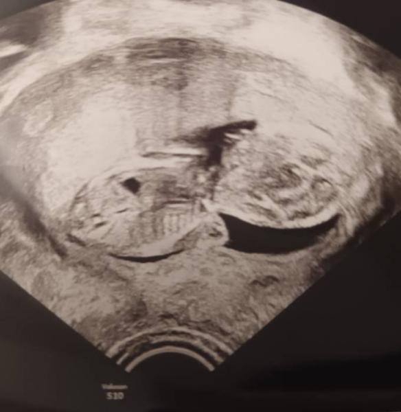 Bild zu Geschlecht erkennen - Forum für November - Mamis