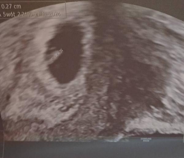 Bild zu 1 Termin mit ultraschall - Forum für November - Mamis