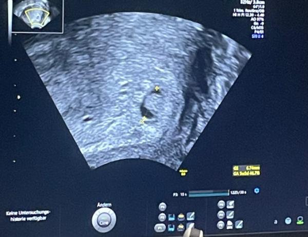 Bild zu Hilfe Ultraschall 5+3 - Forum für November - Mamis