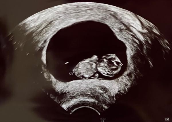 Bild zu 9+4, Ultraschall und Erleicherung - Forum für November - Mamis