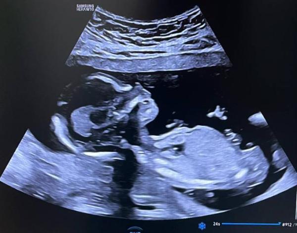 Bild zu Ringelröteln weiterhin hohe Viruslast - Forum für November - Mamis