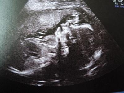 Bild zu Zurück vom Differenzialultraschall - Forum für Dezember - Mamis