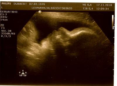Bild zu Heute auch VU gehabt -und alles super!!!!!! Megafreu!!! - Forum für Dezember - Mamis