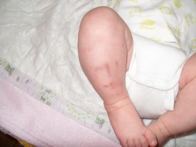 Bild zu Unerklärliche Blaue Flecke. - Forum für Dezember - Mamis