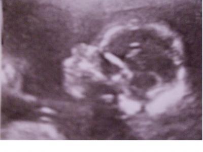 Bild zu Bericht von der Feindiagnostik - Forum für Dezember - Mamis