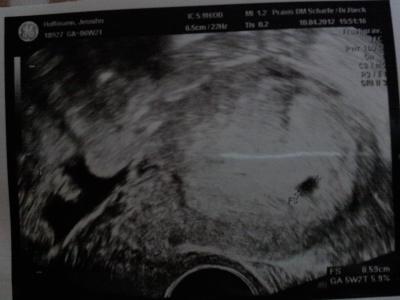 Bild zu Verdacht auf Pilzinfektion bestätigt - Forum für Dezember - Mamis