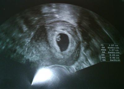 Bild zu Eure ersten Ultraschallbilder und momentanen Beschwerden - Forum für Dezember - Mamis