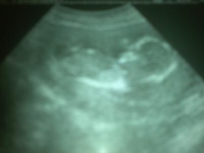 Bild zu Ultraschall Bild - Forum für Dezember - Mamis