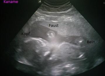 Bild zu 2.Screening - Organultraschall - Forum für Dezember - Mamis
