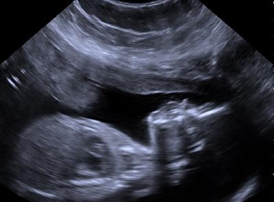 Bild zu Jetzt 23. Woche und heute Feindiagnostik - Forum für Dezember - Mamis