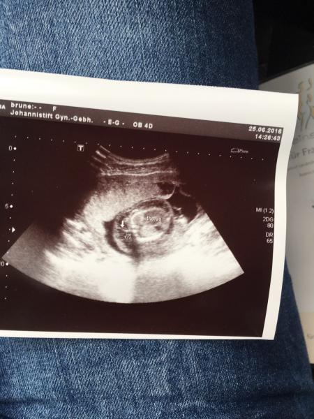 Bild zu Merkwürdiger Ring um Babys Brustkorb - Forum für Dezember - Mamis