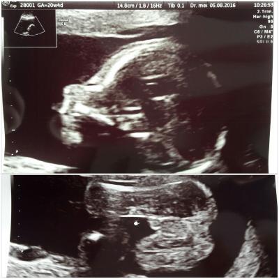 Bild zu Ergebnis der Feindiagnostik :) - Forum für Dezember - Mamis